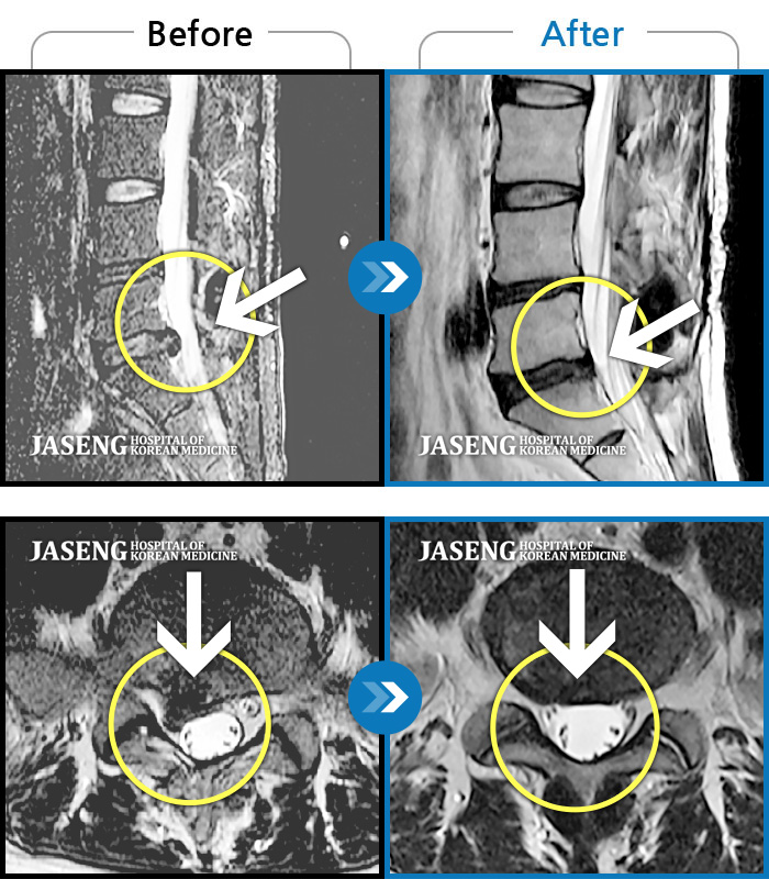창원자생한방병원 치료사례 MRI로 보는 치료결과-허리에서 다리까지 통증