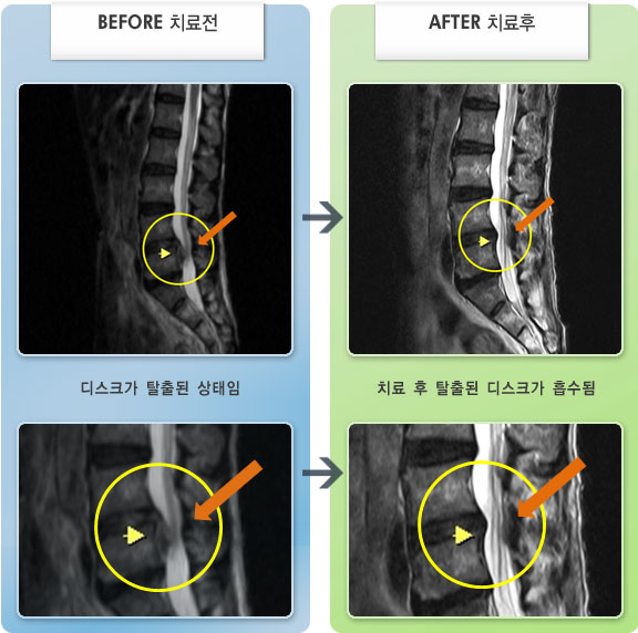 창원자생한방병원 치료사례 MRI로 보는 치료결과-허리디스크로 인한 오른쪽 다리 통증