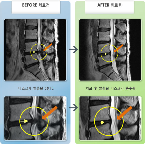 창원자생한방병원 치료사례 MRI로 보는 치료결과-왼쪽 엉치에서 종아리 외측 통증