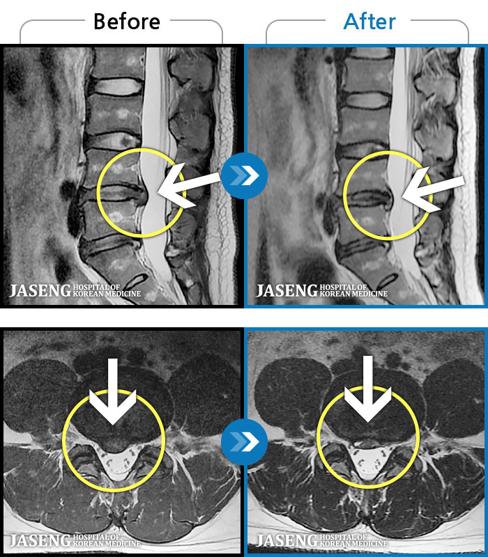 Ȼڻѹ溴 ġ MRI  ġ- 㸮  