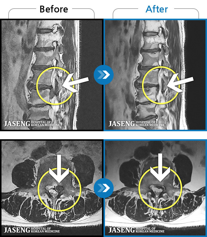 û���ڻ��ѹ溴�� ġ���� MRI�� ���� ġ����-�㸮 ���� �� ���� ��� ������ ���Ͽ� �ϻ��Ȱ�� ������ ���¿����ϴ�.