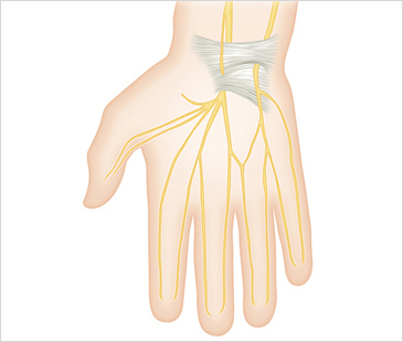 창원자생한방병원 기타관절질환 손목터널증후군-손목터널증후군에 관련된 이미지 입니다.
