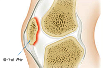 창원자생한방병원 무릎질환 슬개골연골연화증-슬개골 연골이 위치해 있는 무릎 설명 이미지