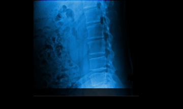 창원자생한방병원 허리질환 척추후만증-척추후만증에 관련된 이미지 입니다.