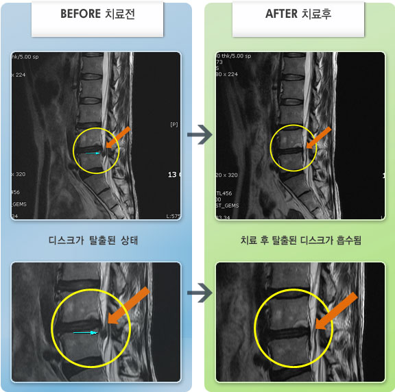 자생한방병원 치료사례 MRI로 보는 치료결과-우측 다리의 당기고 저린 느낌 및 우측 발가락과 발목의 근력저하