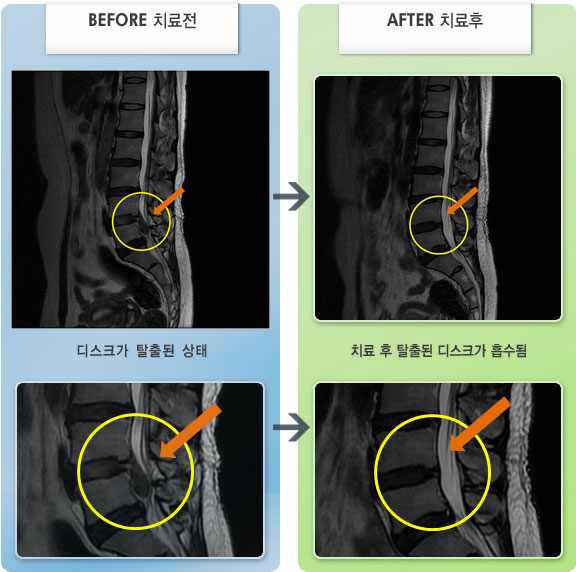 자생한방병원 치료사례 MRI로 보는 치료결과-지속적인 요통을 느껴 신경주사 치료 후 허리와 왼쪽 다리 저림 증상이 증가한 상태