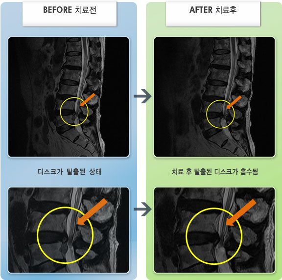 자생한방병원 치료사례 MRI로 보는 치료결과-갑자기 허리 통증이 발생 및 좌측 다리 전체가 저림. 보행시나 물건 들때 증상이 증가