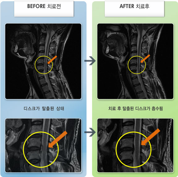 자생한방병원 치료사례 MRI로 보는 치료결과-좌측 팔부터 1-2번째 손가락까지 저림과 통증이 심하였다.