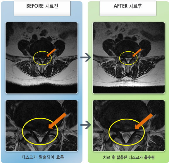 자생한방병원 치료사례 MRI로 보는 치료결과-허리 통증과 좌측 허벅지부터 발끝까지 통증이 내려왔다.