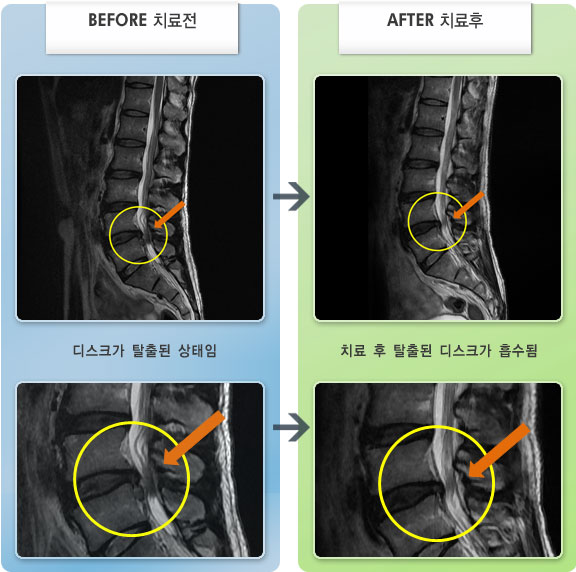 자생한방병원 치료사례 MRI로 보는 치료결과-허리와 엉치 통증이있고 다리가 뒤쪽으로 저린 상태