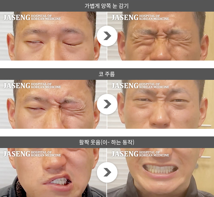 대구자생한방병원-안면신경마비 치료 사례